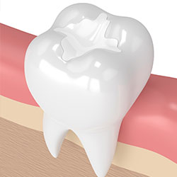 dental fillings at top rated kids dentist
